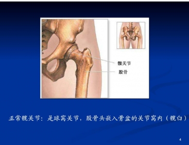 全髋关节置换术护理查房