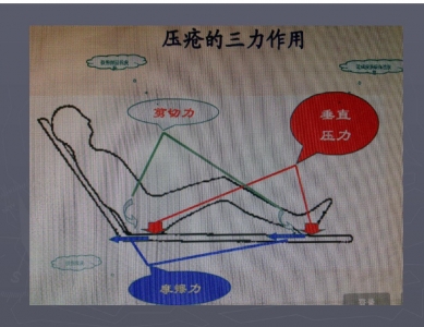 2016压疮护理新进展