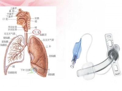 气管切开术后护理