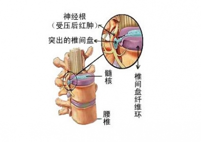 老年骨质疏松性胸腰椎压缩骨折治疗的护理