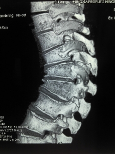 老年骨质疏松性胸腰椎压缩骨折治疗的护理