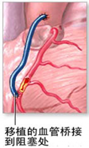 306医院：冠状动脉“搭桥”术的护理