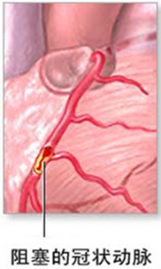 306医院：冠状动脉“搭桥”术的护理