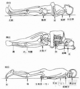 NICE 指南摘要：初级和二级护理中褥疮的预防与处理