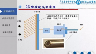 3D胸腔镜下MVR手术配合