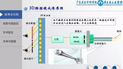 3D胸腔镜下MVR手术配合