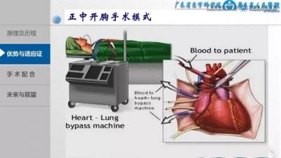 3D胸腔镜下MVR手术配合