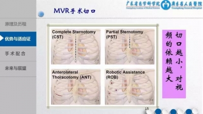 3D胸腔镜下MVR手术配合