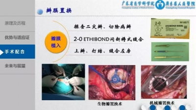 3D胸腔镜下MVR手术配合