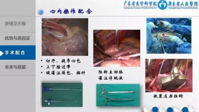 3D胸腔镜下MVR手术配合